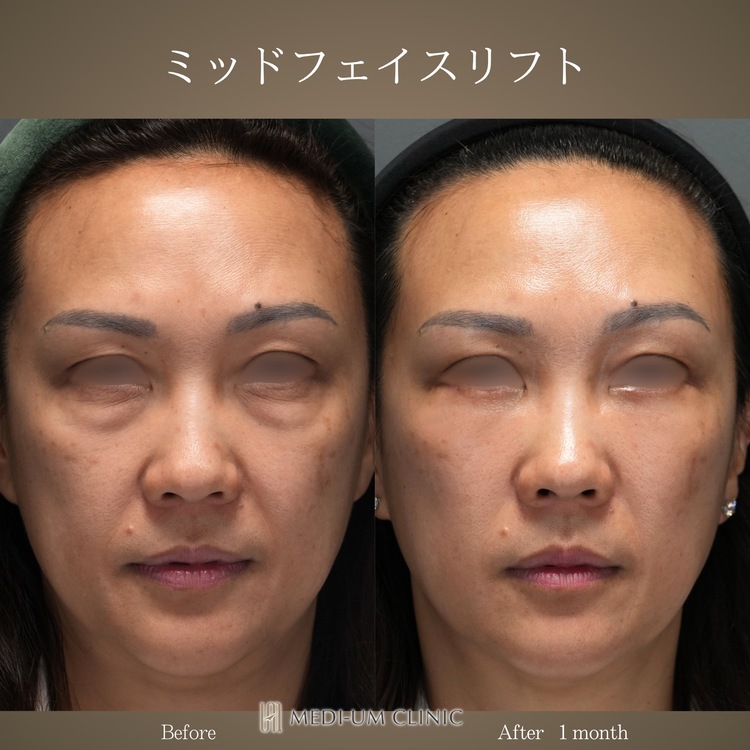 ミッドフェイスリフト 症例②
