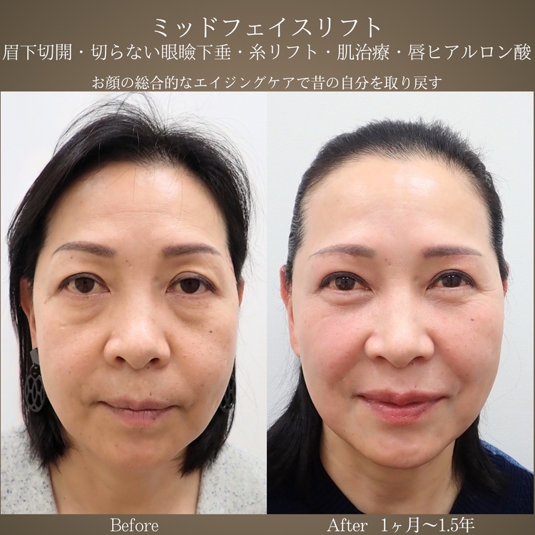 ミッドフェイスリフト 症例③