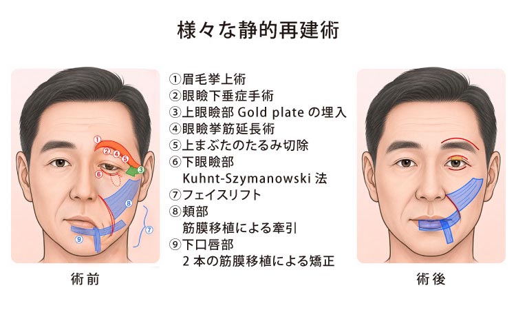 様々な静的再建術